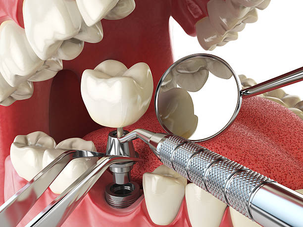 Best Knocked-Out Tooth (Avulsed Tooth) Treatment in Brackettville, TX